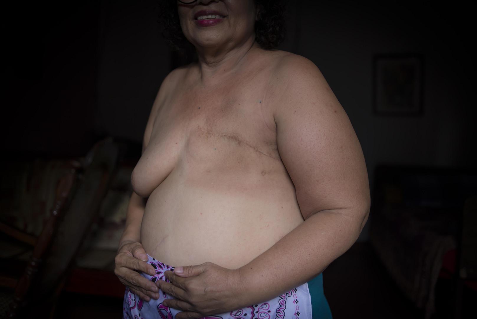 Nicaragua: Cáncer de Mama