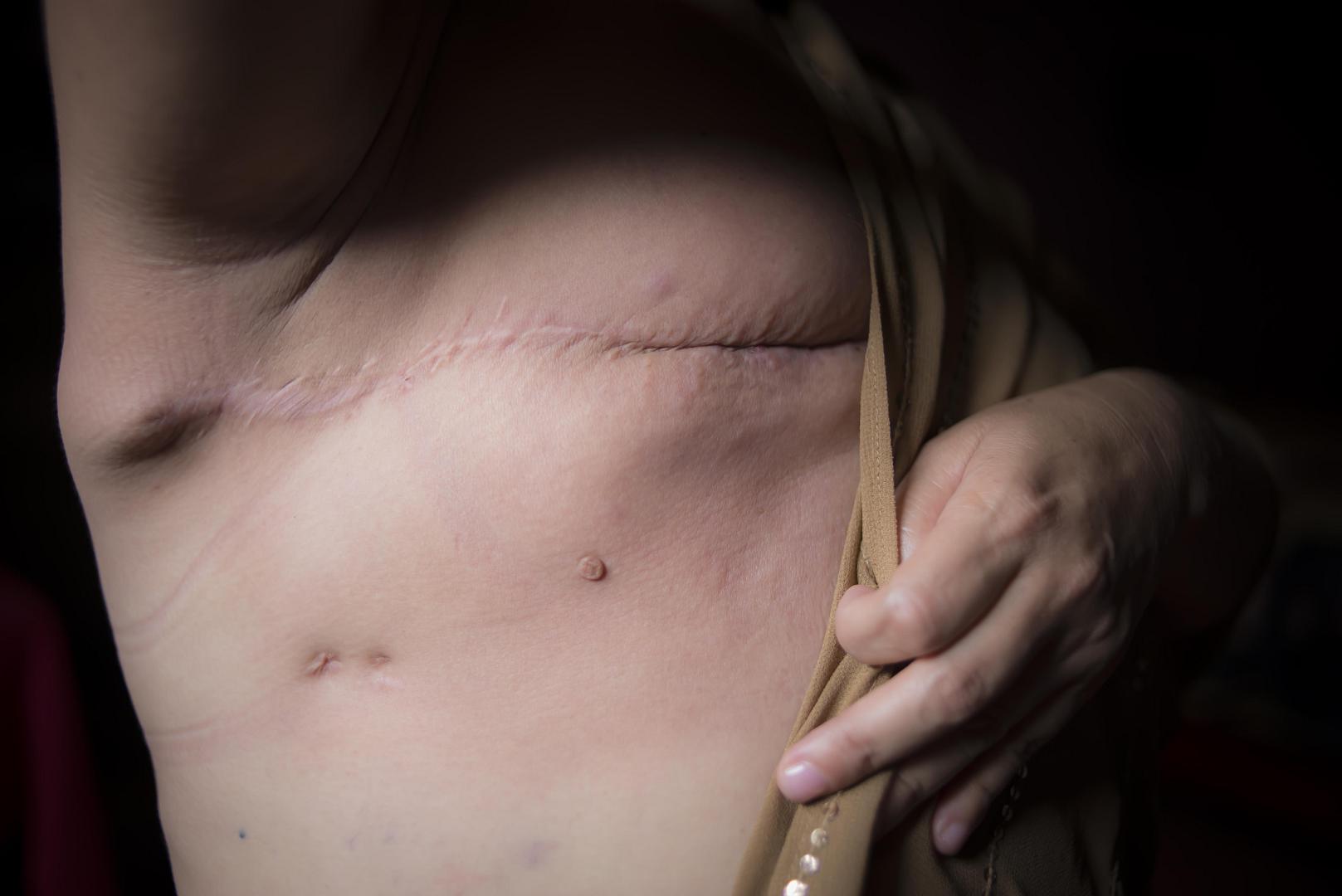 Nicaragua: Cáncer de Mama