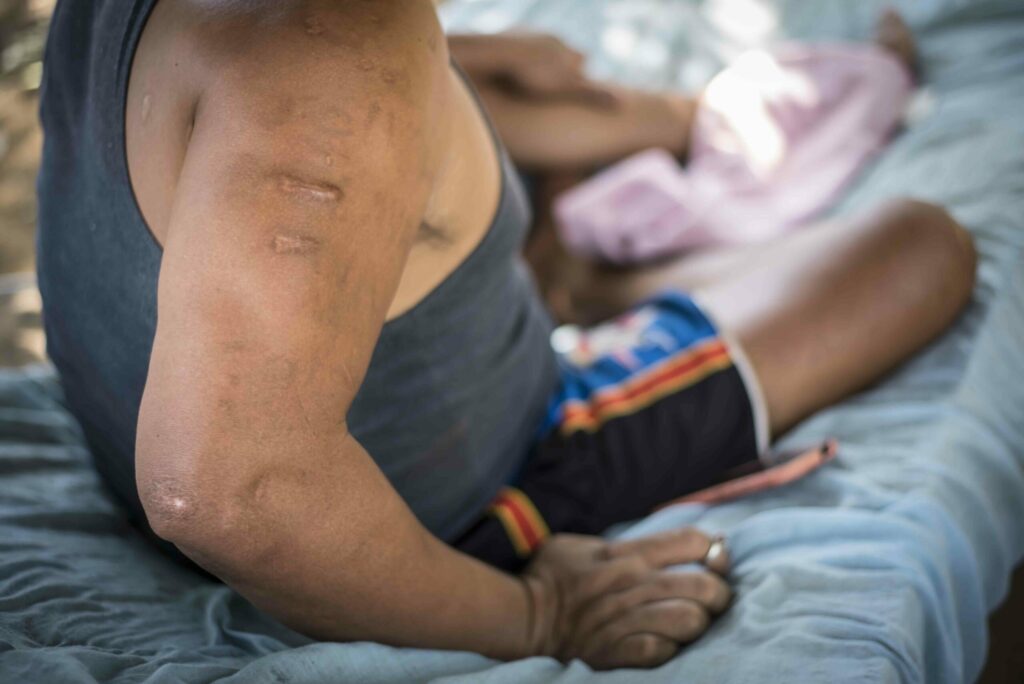 Nicaragua: Lisiados de Abril 2018